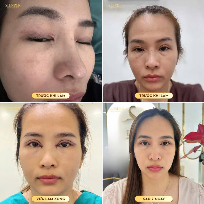 HÀNH TRÌNH SỬA MÍ HỎNG - TÌM LẠI ÁNH NHÌN TỰ NHIÊN TẠI SLENDER